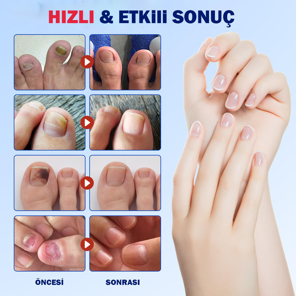 Fungal Nail Patches