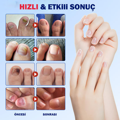 Fungal Nail Patches